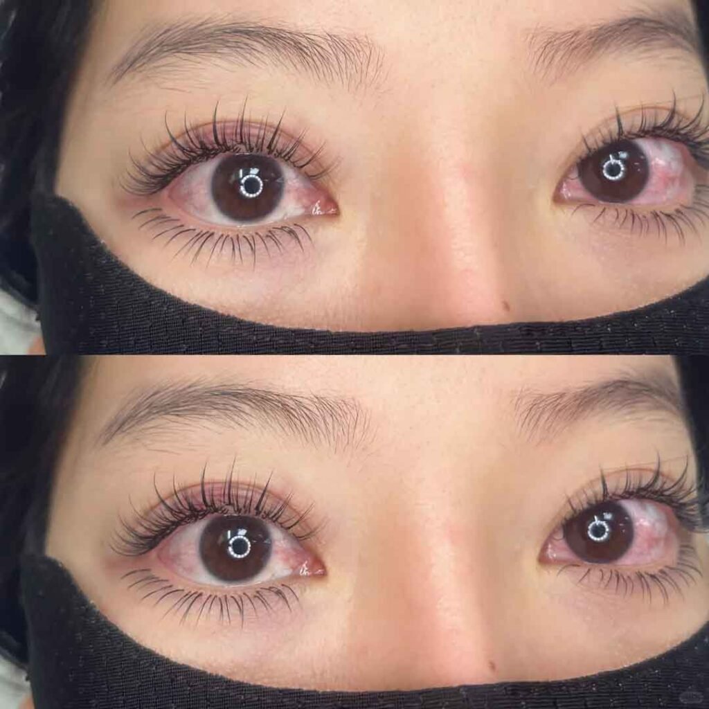 Young woman with active stye wearing lash extensions against medical advice